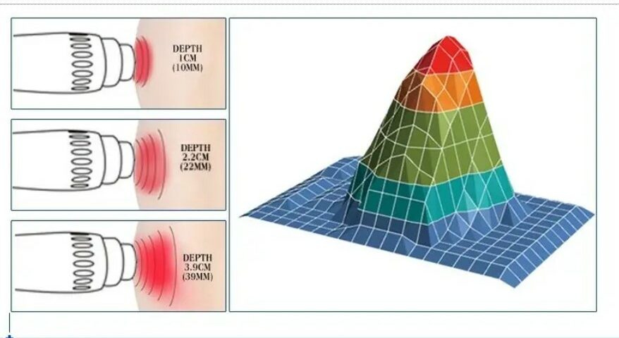 A representation of the force in an ESWT shock wave