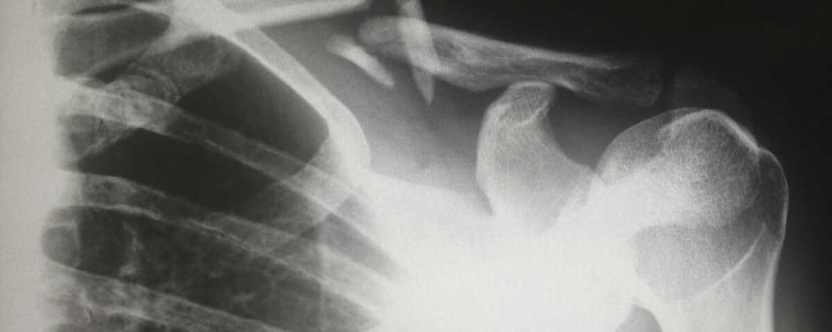 Xray of the Shoulder