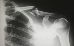 Xray of the Shoulder