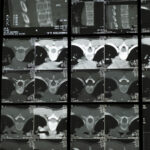 An Xray Montage of Lumbar Disc