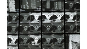An Xray Montage of Lumbar Disc