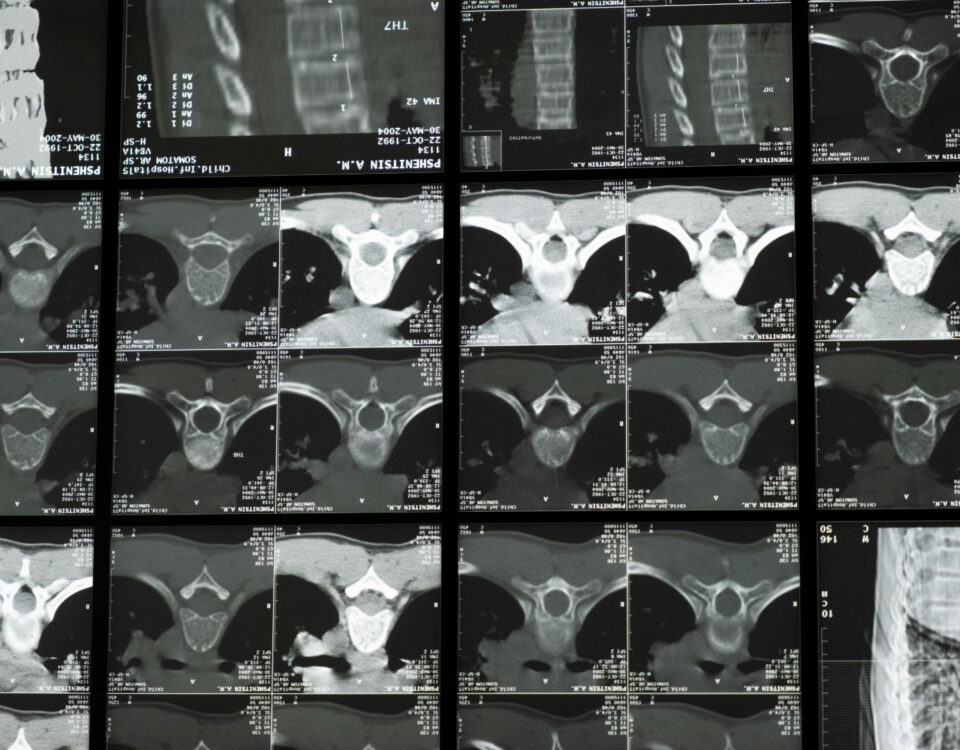 An Xray Montage of Lumbar Disc