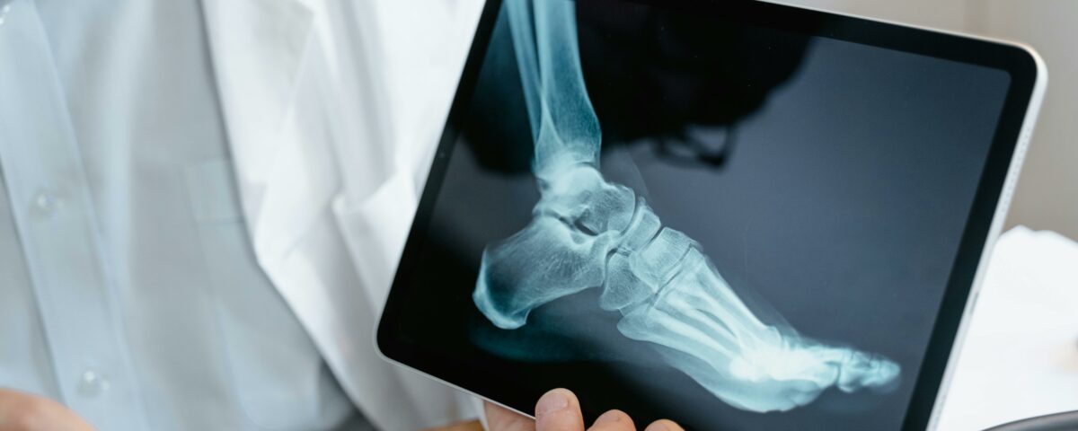 An Xray of a foot to show bobne health